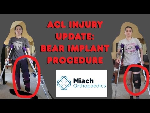 ACL Injury || BEAR Implant Procedure Weeks 1-7