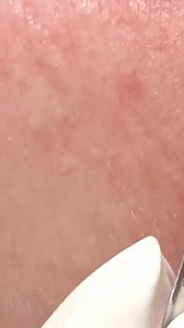Pimple Popper Videos on Instagram: "Blackheads removal #98"