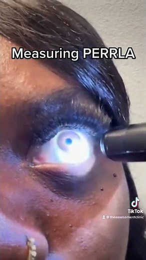 How to measure PERRLA | using penlight