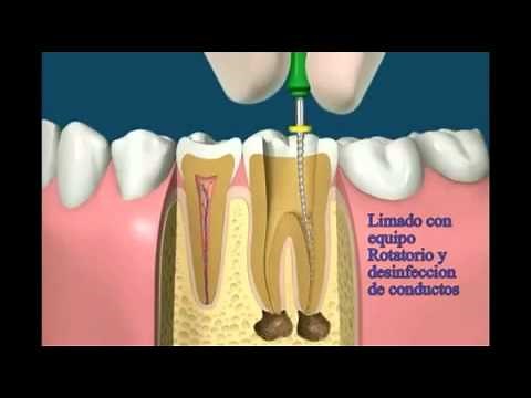 Caries, endodoncia, endoposte y corona.