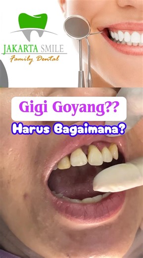 Splinting untuk gigi goyang (0811161061) #doktergigijakartatimur #klinikgigijakartatimur #dentist