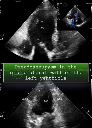 Pseudoaneurysm in the inferolateral wall of the left ventricle