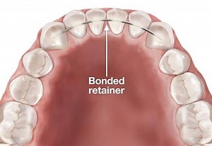 What Are Permanent Retainers and How Do They Work? — Orthodontic Specialists of White Plains