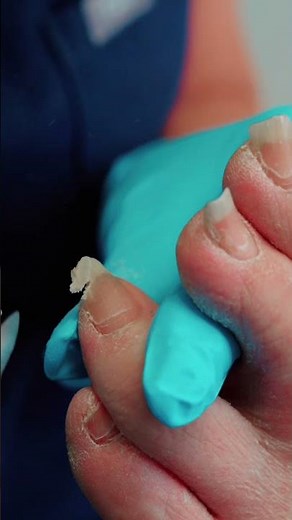 ASMR Toenail Trimming for Diabetic Foot Care | Healthy Feet Podiatry