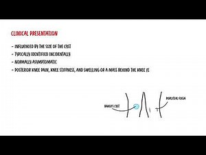 Baker's Cyst Knee • Video • MEDtube.net