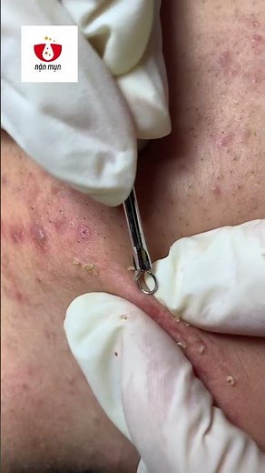 [S 101] NẶN MỤN ĐẦU ĐEN, ĐẦU TRẮNG NHANH, HIỆU QUẢ | ACNE SQUEEZING FAST & EFFECTIVE | © Nặn Mụn