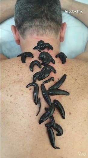 26 Medicinal Leeches for Osteopathic Pain Relief | Hirudo.Clinic London #Hirudotherapy #LeechTherapy