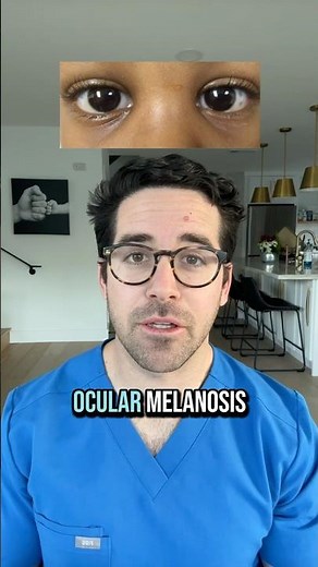 What Is Ocular Melanosis? 👁️ | Dr. Yoshi Explains This Eye Pigmentation
