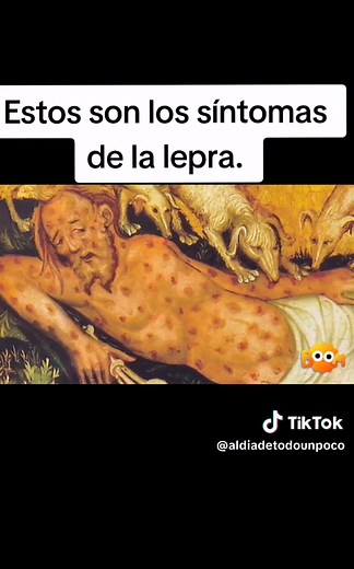 Síntomas de la lepra: Conoce sus signos iniciales y tratamiento