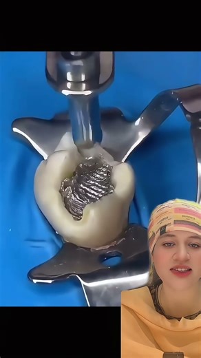 Amalgam filling procedure #drrabiajamil #dentist