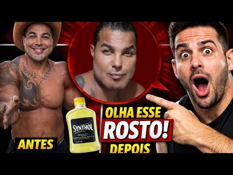 O Rosto Mudou com Synthol?! O Caso Mais Bizarro