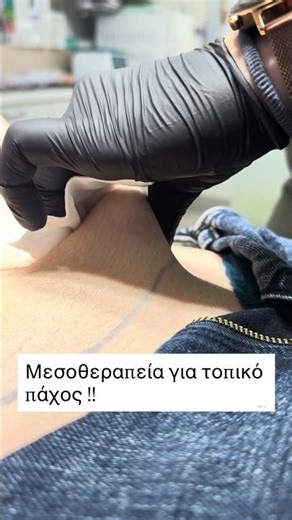 #beforeafter #πλαστικοσχειρουργοσ #plaady #plasticsurgery