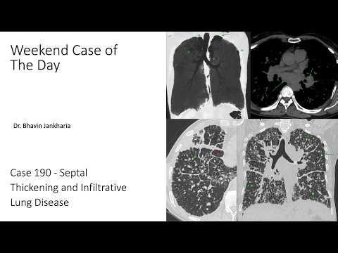 Case of the Day - 190 - Septal Thickening and Infiltrative Lung Disease
