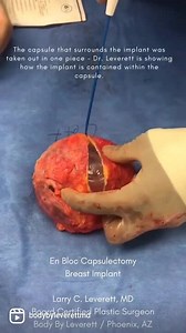 En Bloc Capsulectomy Removal / Explant / Implant Removal