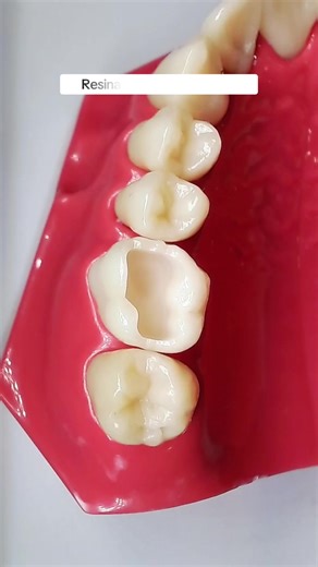Dental Resin Procedures: A Step-by-Step Guide