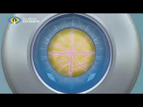 Cataract lens replacement surgery animation video