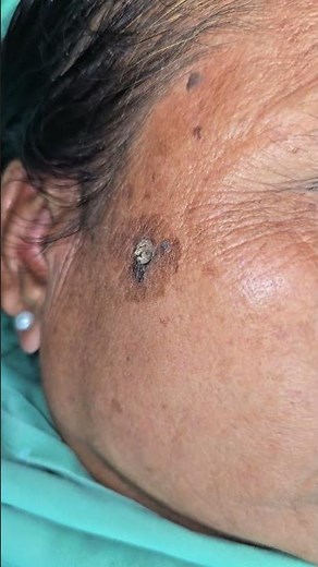 Filiform wart
