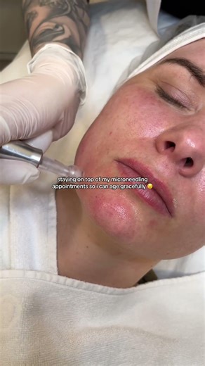 The Secret to Aging Gracefully? Microneedling with Derma SR Serums 💙