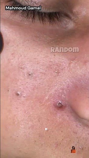 blackhead extractions, blackhead and whitehead removal, blackhead news this week, blackhead