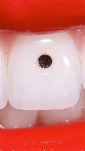 Amazing teeth hole removing | ASMR Studio