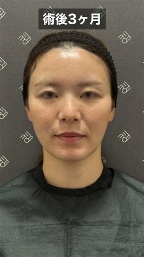 [Full face fat injection] Transforms sagging cheeks caused by orthodontic treatment into a soft, ...