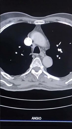 Pulmonary Embolism -CTPA scan showing PE. #manipalhospitalkharadi #medico #radio #emergencymedicine