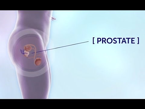 Prostate Cancer Treatment Support | Cancer Research UK