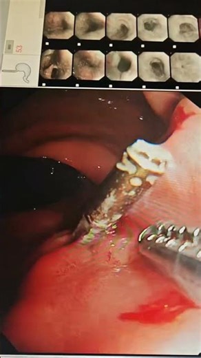 Endoscopic Foreign Body Removal Forceps || Dr.sun #endoscopy