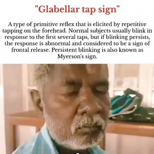 🧠The glabellar reflex, also known as the "glabellar tap sign", is a primitive reflex elicited by repetitive tapping on the forehead. Subjects blink in response to the first several taps. If the blinking persists, this is known as Myerson's sign, and is abnormal and a sign of frontal release; it is often seen in people who have Parkinson's disease.⁣ ⁣ 📝📝The afferent sensory signals are transmitted by the trigeminal nerve to the brain stem; the efferent signals go to the orbicularis oculi muscl