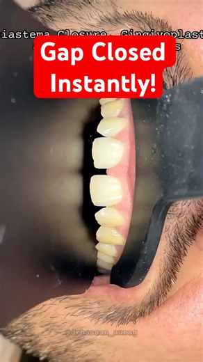 4 Composite Veneers + Diastema Closure | Instant Smile Transformation ✨#shorts #dentist