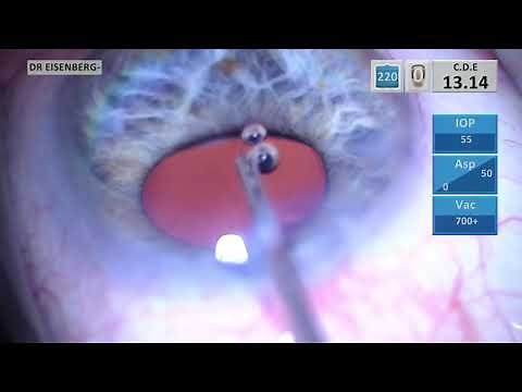 iStent inject surgical technique: Perfect the Inject(W)