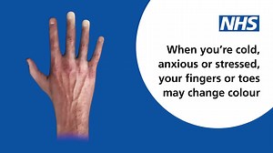 18K views · 140 reactions | Raynaud's is a condition where the small blood vessels of the fingers become narrow, causing fingers to change colour and become painful. Read about how to treat the symptoms on our page. | nhs.uk | Facebook