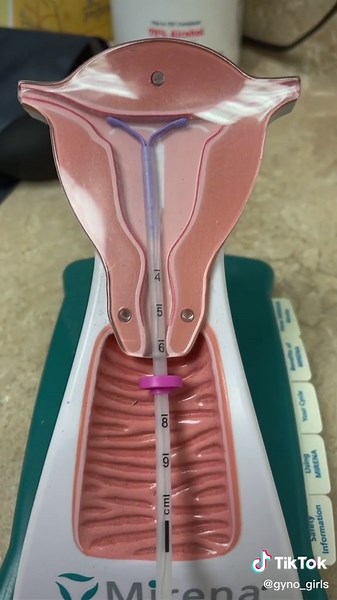 Understanding Your Options for IUD Insertion