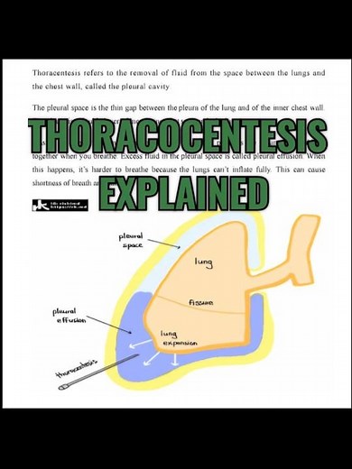 Thoracocentesis (Pleural Tapping) Explained!!!