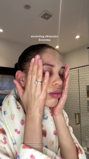 Morning Skincare Routine for Eczema Flare-Up