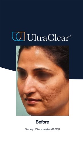 2.1K views · 15 comments | An UltraClear® transformation in just 5...