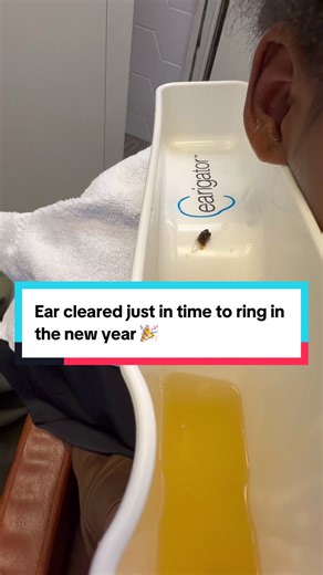She’ll be hearing into next year. So glad we could clear this massive ball of wax out quickly! Like and follow for more ear shenanigans. Www.oraclehearingcenter.com #oraclehearingcenter #lawrencevillenj #earwaxremoval #earwaxextraction #earigator hearingloss audiologist earwax ears drpimplepopper hearingloss satisfyingvideos satisfying qtips ears cloggedears