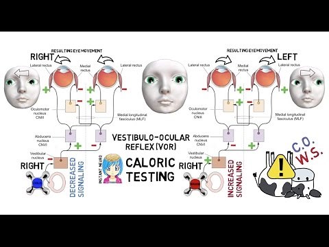 INSTANT NEURO - Caloric Testing