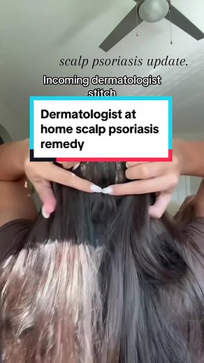 Effective At-Home Scalp Psoriasis Remedy Using Apple Cider Vinegar and Aspirin