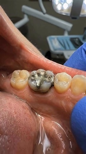 Estamos viendo un procedimiento dental donde se retira un empaste antiguo de amalgama y se reemplaza por uno de resina, mostrando cómo el diente recupera su apariencia natural mientras se restaura su función.