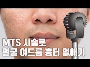 How to get rid of facial acne scars with dermatology MTS procedure