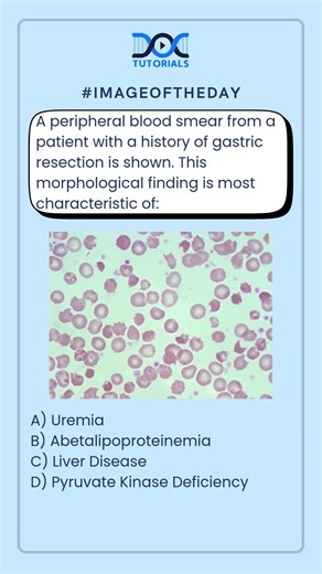 This morphological finding is most characteristic of:
