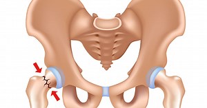 Femoral neck stress fracture: Signs, symptoms, diagnosis, and treatment | Dr Geier
