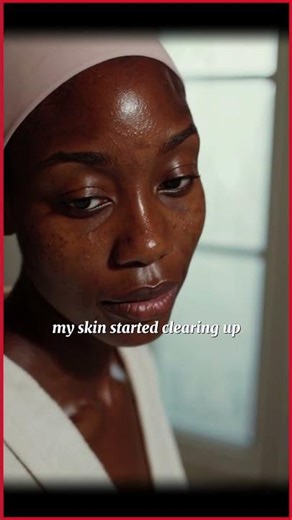 Anti-Acne Cream – Friend Recommendation Angle