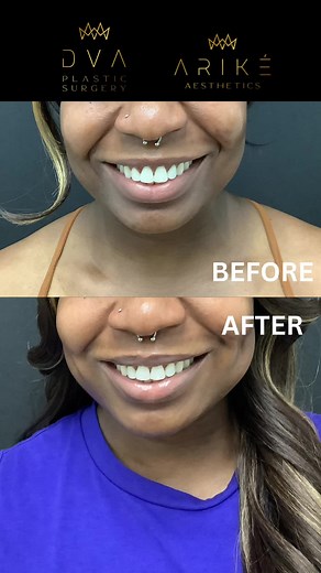 Dreaming of dimples? ✨ Dimpleplasty at DVA Plastic Surgery creates natural-looking dimples with minimal downtime and long-lasting results. Interested in learning more? Call or Text us: 713-581-1858 #Dimpleplasty #CosmeticSurgery #HoustonBeauty #PlasticSurgery #DVAPlasticSurgery #HoustonPlasticSurgery #HoustonMedSpa #Dimpleplastyprocedure #cosmeticsurgery #houstontx #houstoncosmeticsurgery #medspa #dimplesurgery