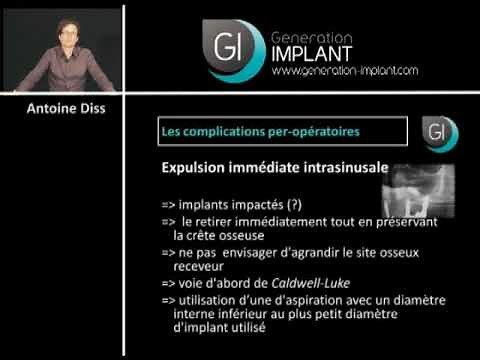 Implants dentaires : Les complications