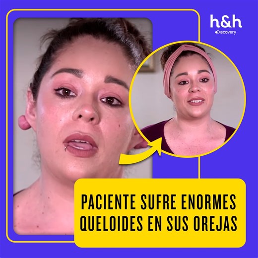 23K views · 157 reactions | Una perforación terminó en un infierno para esta paciente: queloides extremos cambiaron su vida. ¿Podrá la Dra. Lee ayudarla? ‍⚕️⚠️ #SandraLee Disfruta el contenido de Discovery en MAX. Suscríbete ahora: <https://bit.ly/MAX-HHLAT> | Discovery Home & Health | Facebook
