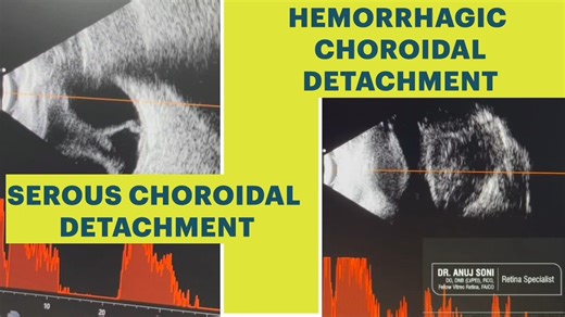 眼部B超：脉络膜脱离 | Choroidal Detachment : Haemorrhagic Vs Serous- Atlas of B scan