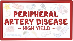 Peripheral artery disease: Pathology review: Video, Causes, & Meaning | Osmosis