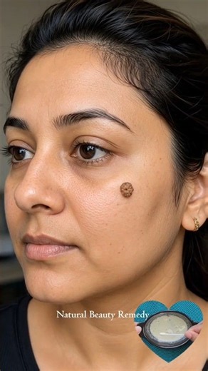 Face Warts 😳 Try This Easy Natural Care for Smoother, Clearer-Looking Skin! ✨ #WartRemoval #SkinCare